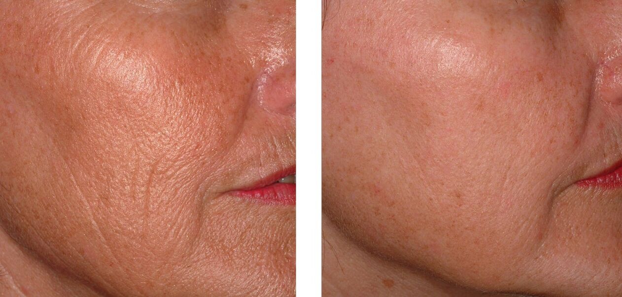 Skin rejuvenation