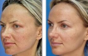 Pelado laser