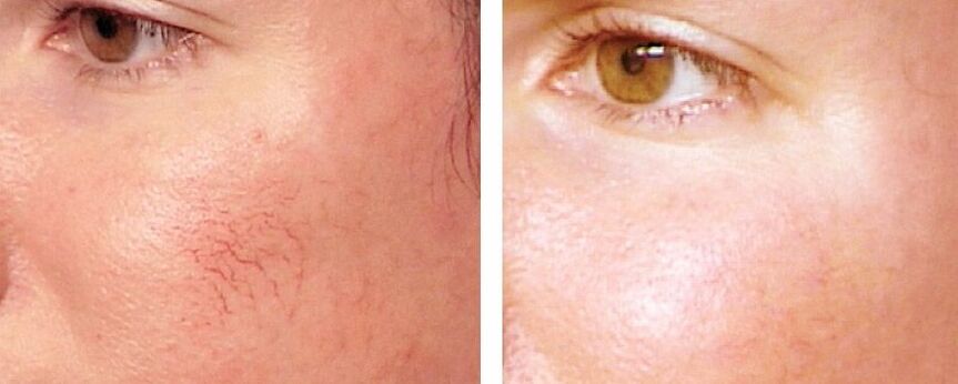 Rosacea elimination