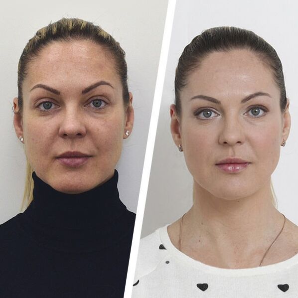 Before and after facial skin rejuvenation without surgery.