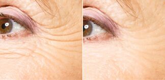 Before and after fractional rejuvenation.
