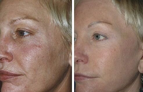 fractional laser resurfacing before and after photos