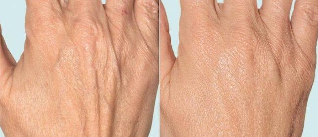 Hand skin before and after fractional therapy.