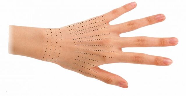 Injection sites for hands during biorevitalization.