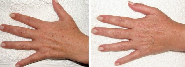 Result of removing pigment stains on the hands.