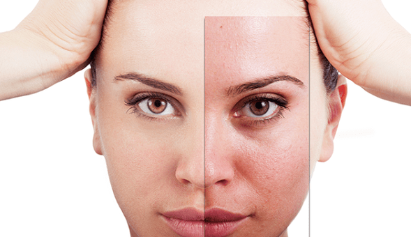Fractional rejuvenation eliminates the main aesthetic defects of the face. 