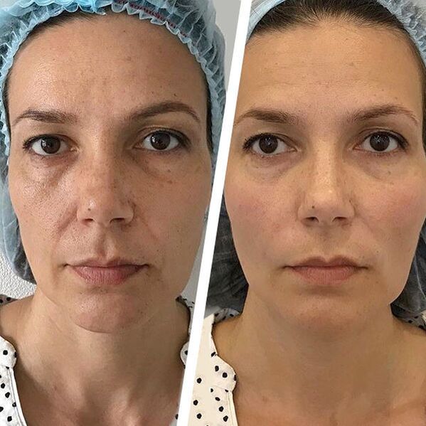 photo of the face before and after laser resurfacing